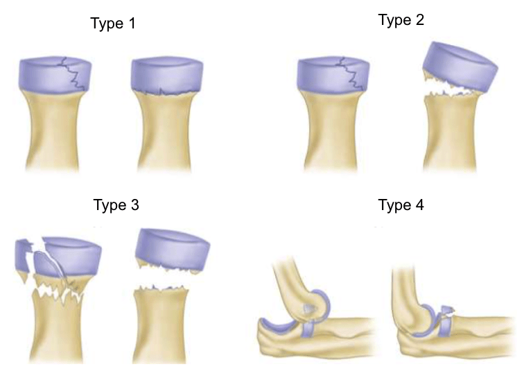 Mason classification of radial head and neck fractures